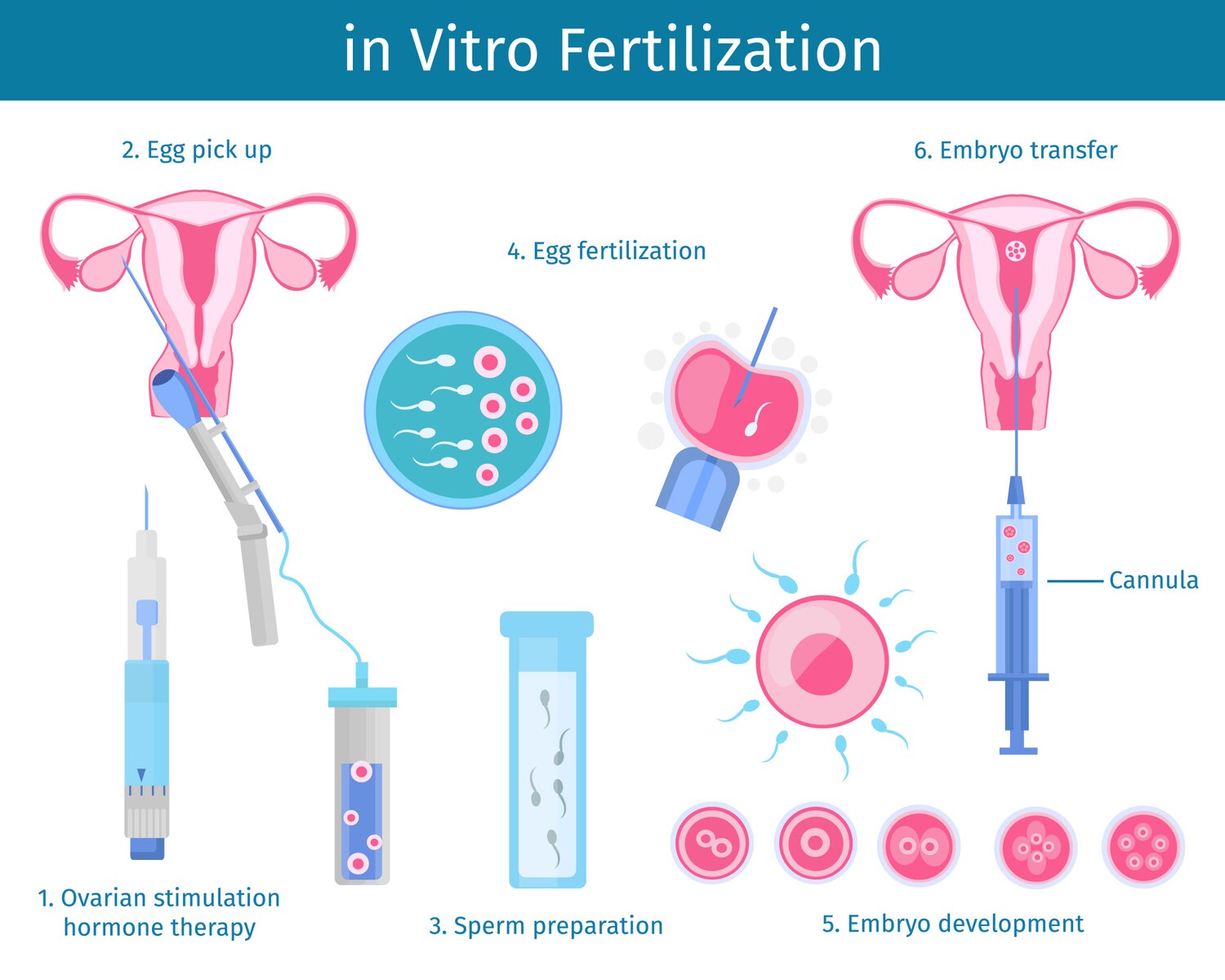 vitro fertilization